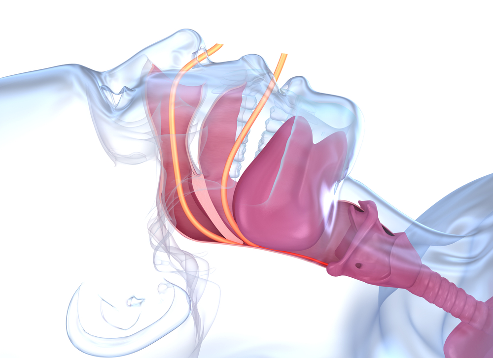 Sleep apnea syndrome, nasal tongue blocked airway