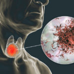 3D illustration showing tumor inside thyroid gland and closeup view of cancer cells