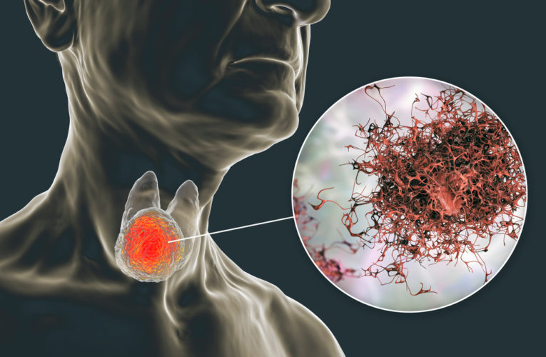 3D illustration showing tumor inside thyroid gland and closeup view of cancer cells