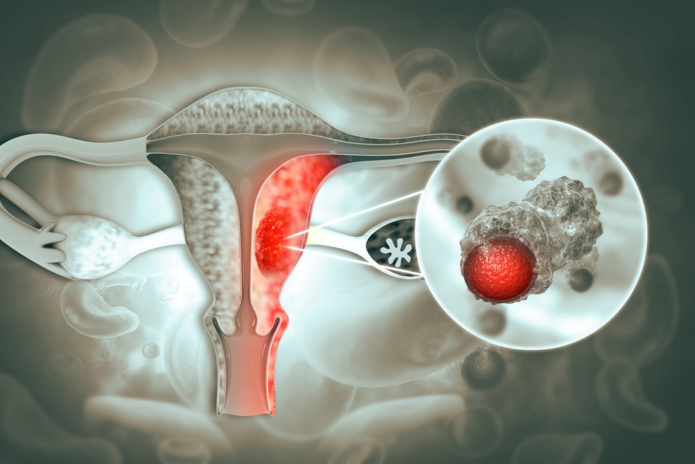 Uterus cancer and endometrial malignant tumor