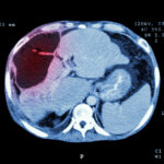 CT scan of upper abdomen showing abnormal mass on liver that is Liver cancer