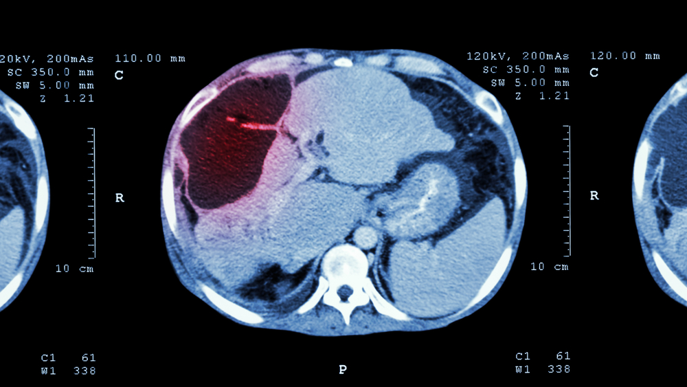 CT scan of upper abdomen showing abnormal mass on liver that is Liver cancer