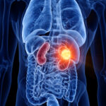 3d rendered medically accurate illustration of kidney cancer