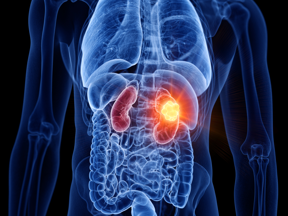 3d rendered medically accurate illustration of kidney cancer