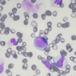 closeup of leukemia blast cells