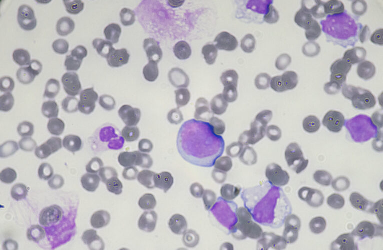 closeup of leukemia blast cells