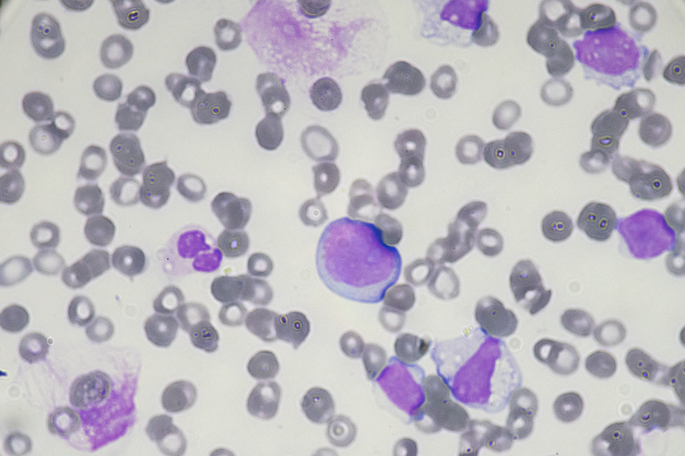 closeup of leukemia blast cells