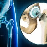3D rendering of an x-ray of a total hip replacement