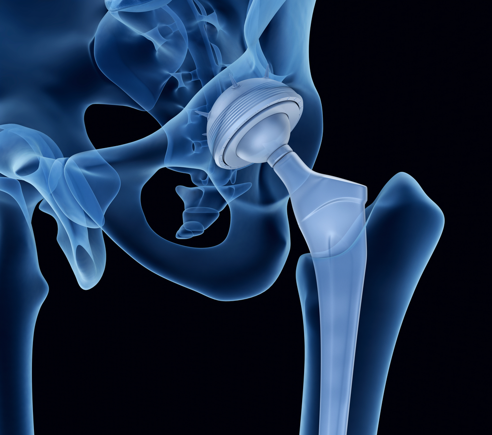 Hip replacement implant installed in the pelvis bone.