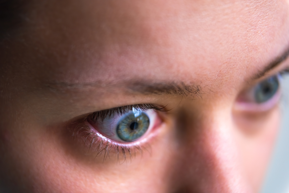 closeup profile portrait of young woman face with Grave's disease hyperthyroidism symptoms of ophthalmopathy bulging eyes