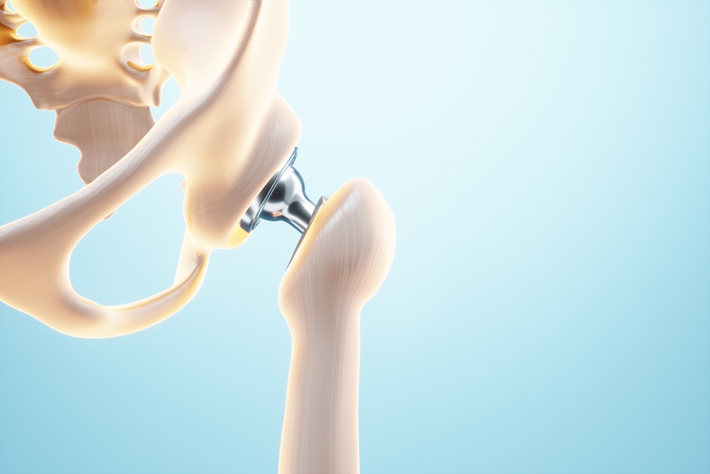 3D image of a hip implant with a light blue background