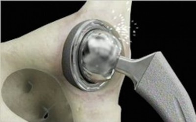 hip debris - Hip Replacement Survivors, Facebook