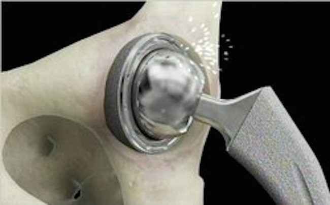 hip debris - Hip Replacement Survivors, Facebook